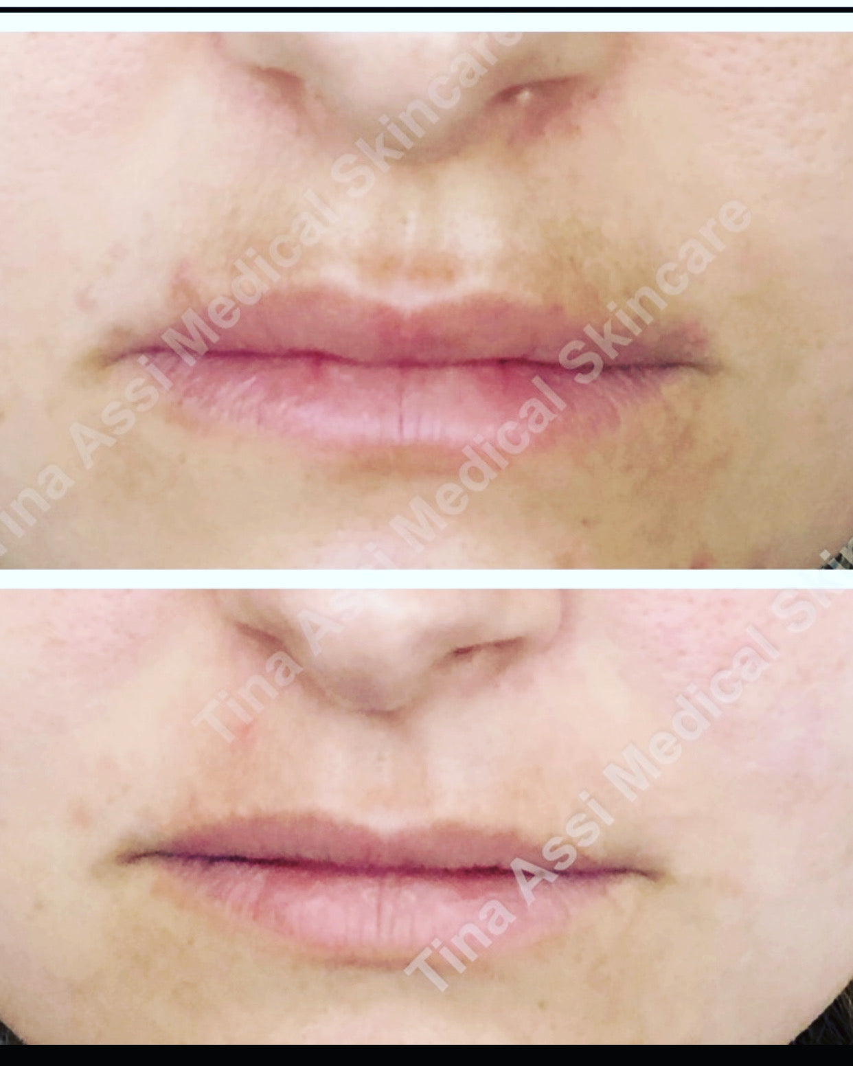 Professional Pigment Correction Pads (6% Hydroquinone)Topix pharmaceutical