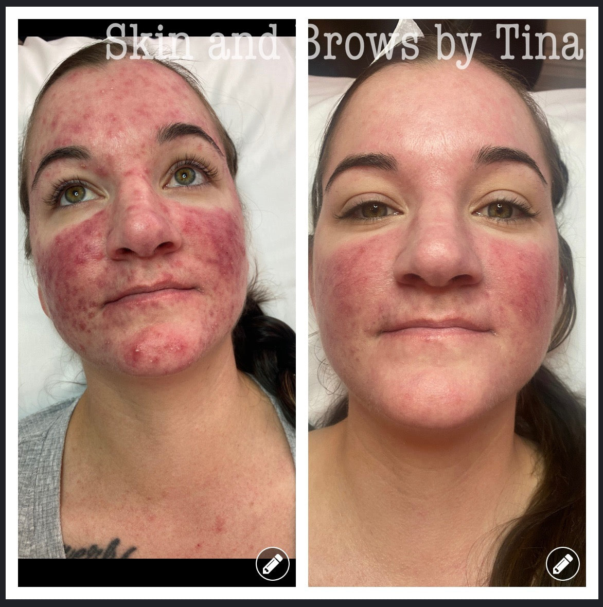 Inflamed, acne-prone skin